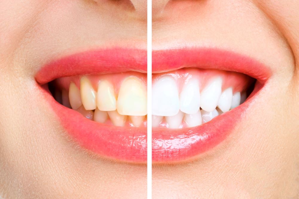 teeth-whitening-0002